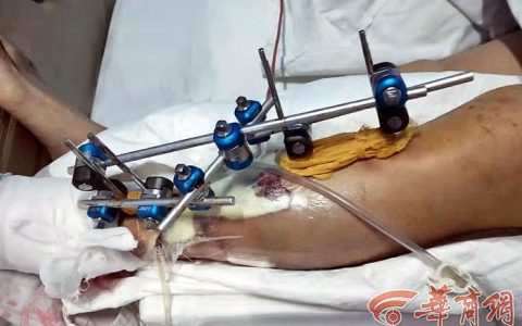 装卸白糖时砸到腿上骨折 打零工的赔偿费用谁承担？